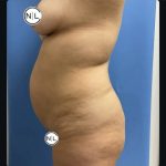 Abdominoplasty Before & After Patient #14725