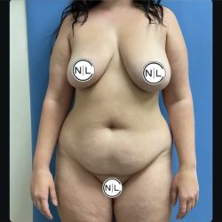 Abdominoplasty Before & After Patient #14736