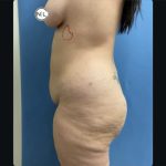 Abdominoplasty Before & After Patient #14736