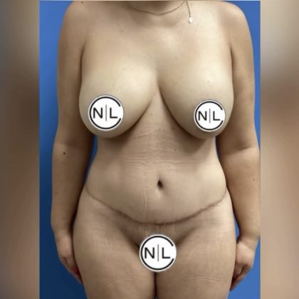 Abdominoplasty Before & After Patient #14752
