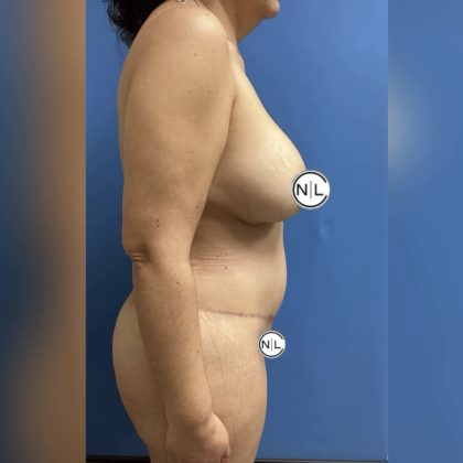 Abdominoplasty Before & After Patient #14752