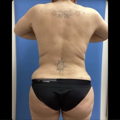 Brazilian Butt Lift Before & After Patient #14884