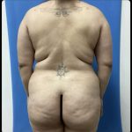 Brazilian Butt Lift Before & After Patient #14884
