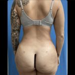 Brazilian Butt Lift Before & After Patient #14883