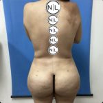 Brazilian Butt Lift Before & After Patient #14882