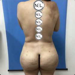 Brazilian Butt Lift Before & After Patient #14882