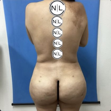 Brazilian Butt Lift Before & After Patient #14882