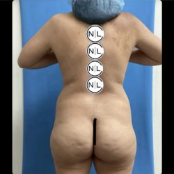 Brazilian Butt Lift Before & After Patient #14882