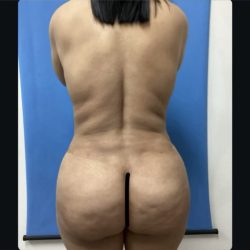 Brazilian Butt Lift Before & After Patient #15178
