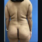 Brazilian Butt Lift Before & After Patient #15178