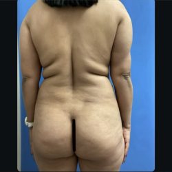 Brazilian Butt Lift Before & After Patient #15178
