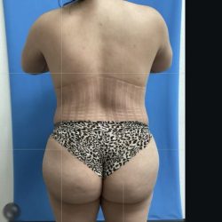 Brazilian Butt Lift Before & After Patient #14879