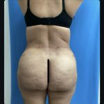 Brazilian Butt Lift Before & After Patient #14877