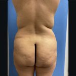 Brazilian Butt Lift Before & After Patient #14877