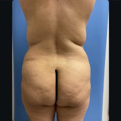Brazilian Butt Lift Before & After Patient #14877