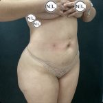 Brazilian Butt Lift Before & After Patient #14876