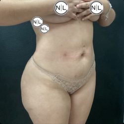 Brazilian Butt Lift Before & After Patient #14876