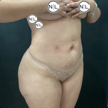 Brazilian Butt Lift Before & After Patient #14876