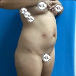 Brazilian Butt Lift Before & After Patient #14876