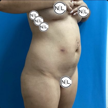Brazilian Butt Lift Before & After Patient #14876