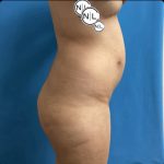 Brazilian Butt Lift Before & After Patient #14876