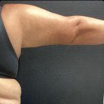Brachioplasty Before & After Patient #14843