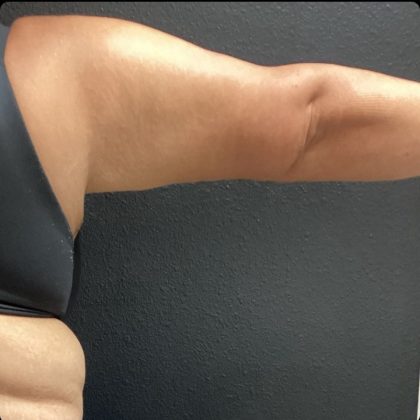 Brachioplasty Before & After Patient #14843