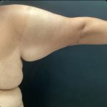 Brachioplasty Before & After Patient #14843