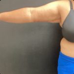 Brachioplasty Before & After Patient #14843
