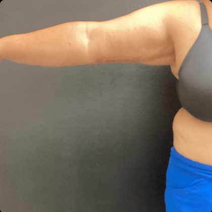 Brachioplasty Before & After Patient #14843