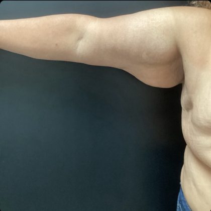 Brachioplasty Before & After Patient #14843