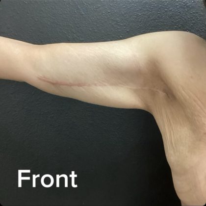 Brachioplasty Before & After Patient #14842