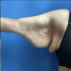 Brachioplasty Before & After Patient #14842