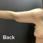 Brachioplasty Before & After Patient #14842