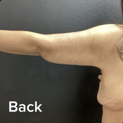 Brachioplasty Before & After Patient #14842