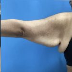 Brachioplasty Before & After Patient #14842