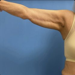 Brachioplasty Before & After Patient #14841