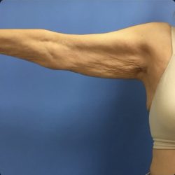 Brachioplasty Before & After Patient #14841