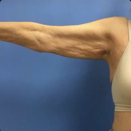 Brachioplasty Before & After Patient #14841