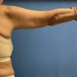 Brachioplasty Before & After Patient #14841