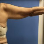 Brachioplasty Before & After Patient #14841
