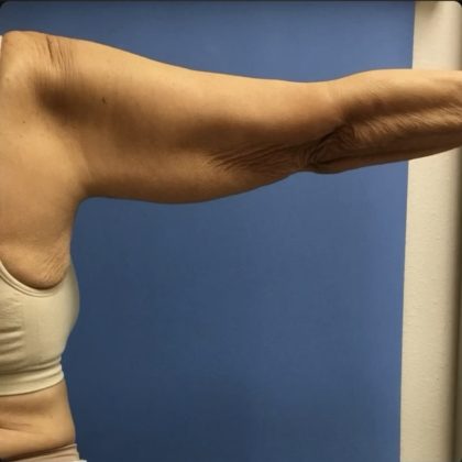 Brachioplasty Before & After Patient #14841