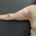 Brachioplasty Before & After Patient #14840