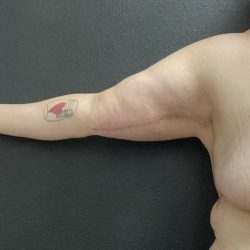 Brachioplasty Before & After Patient #14840