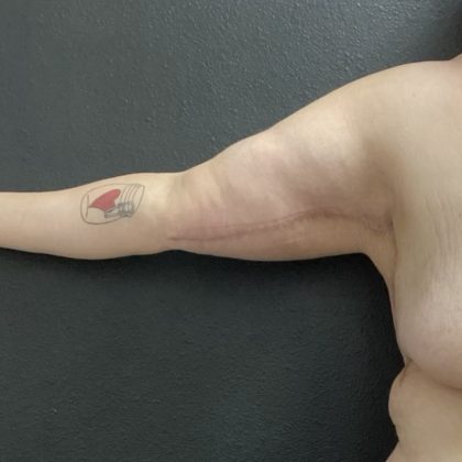 Brachioplasty Before & After Patient #14840