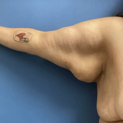 Brachioplasty Before & After Patient #14840