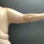 Brachioplasty Before & After Patient #14840