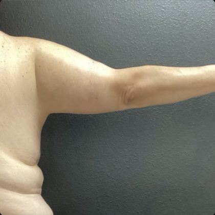 Brachioplasty Before & After Patient #14840