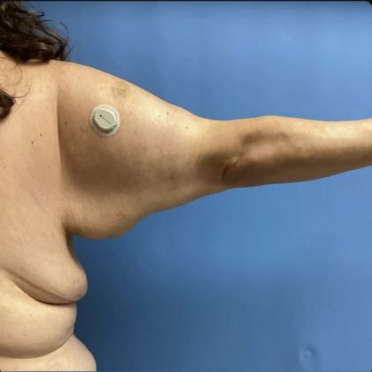Brachioplasty Before & After Patient #14840