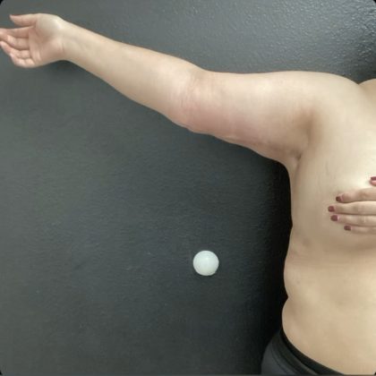 Brachioplasty Before & After Patient #14839